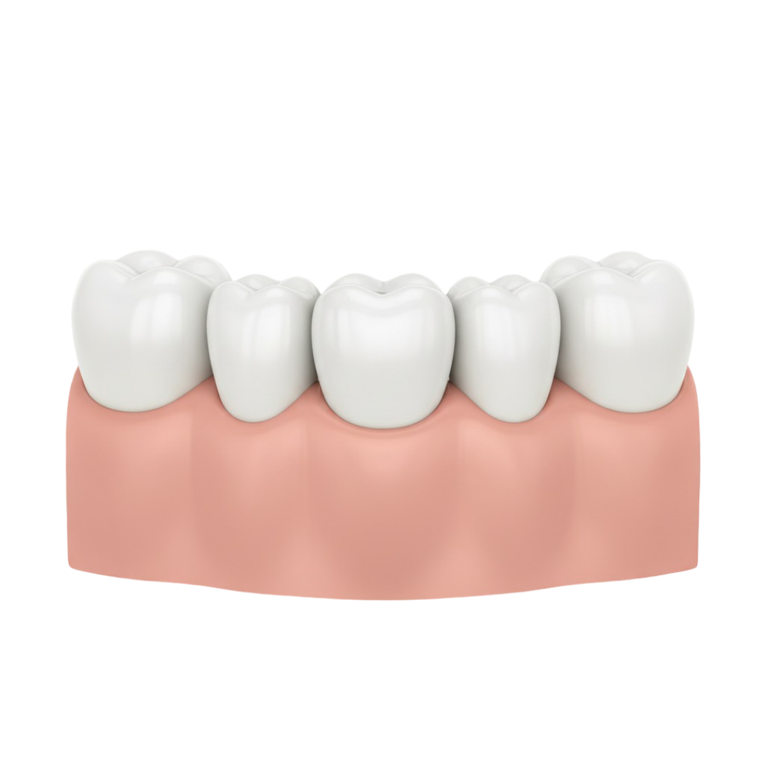 Dental Bridges